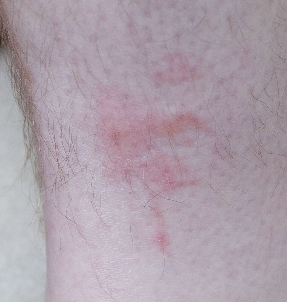 Taches de sang laissées par les punaises de lit sur les draps